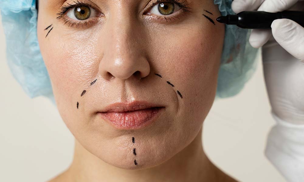 botox for marionette lines