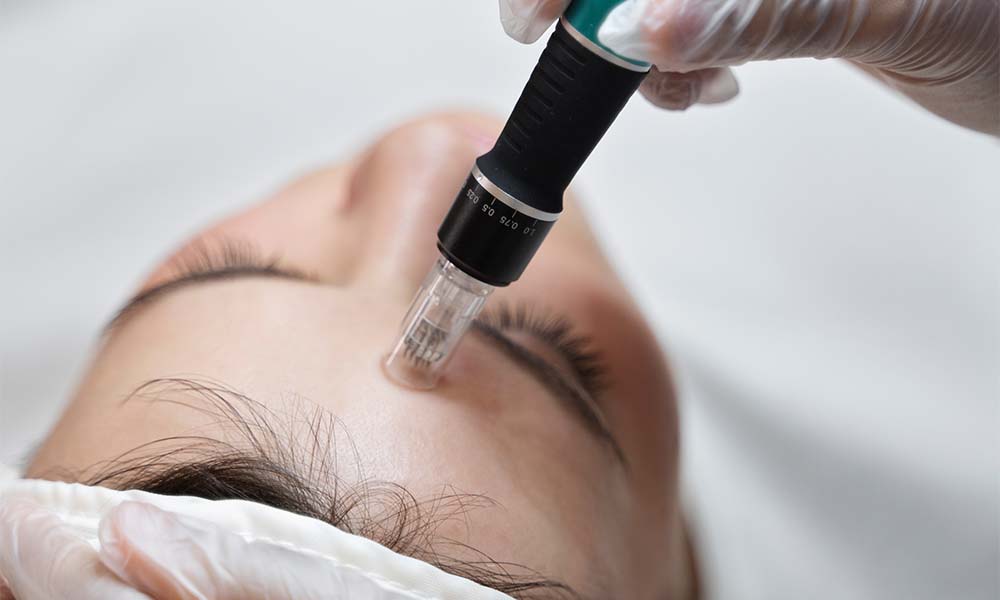 how much does skinpen microneedling cost