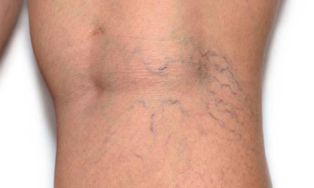 how to get rid of spider veins naturally in 3 minutes