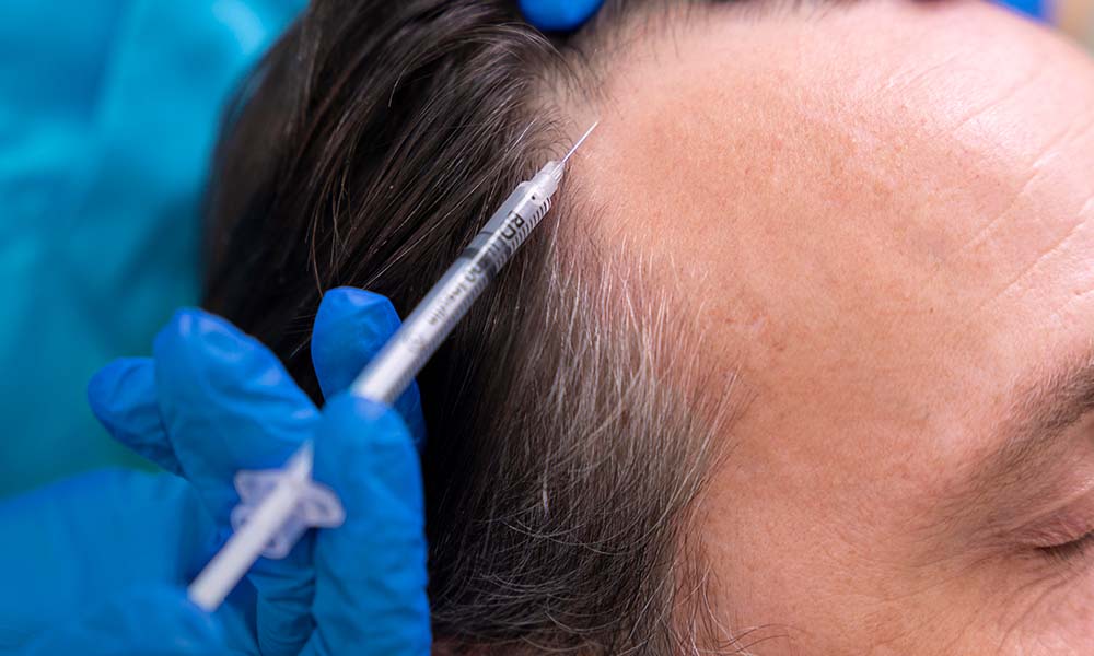 prp injections for hair loss