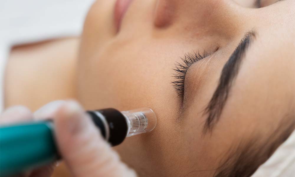 skinpen microneedling