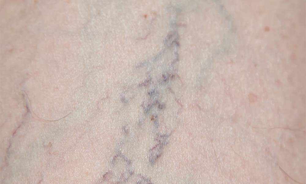 spider veins
