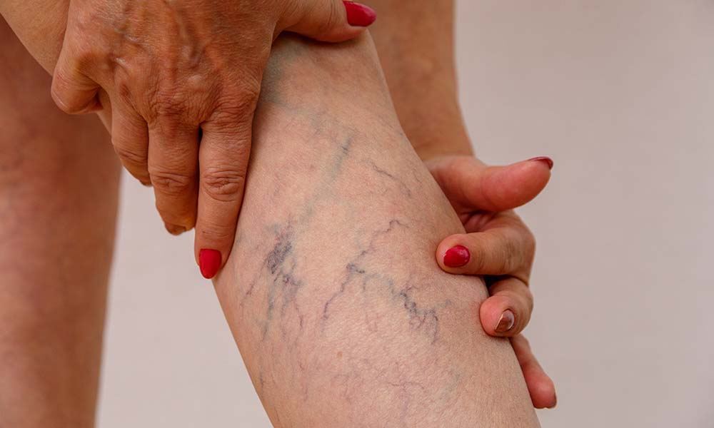 what causes spider veins