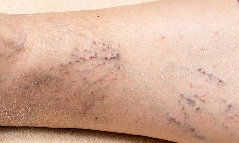 laser spider vein removal