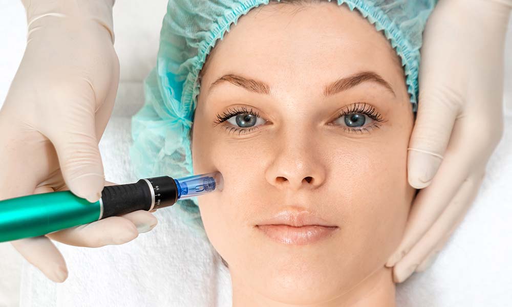 skinpen microneedling