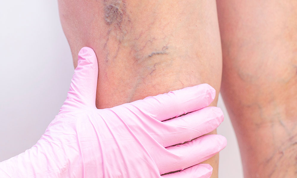 how much does spider vein removal cost