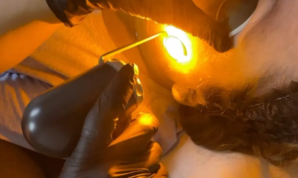 advatx laser before and after