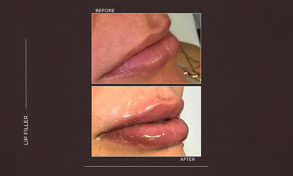 dermal filler before and after